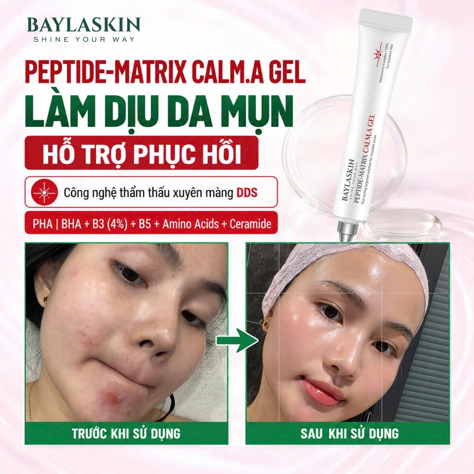 Cách trị mụn ẩn dưới da hiệu quả, an toàn