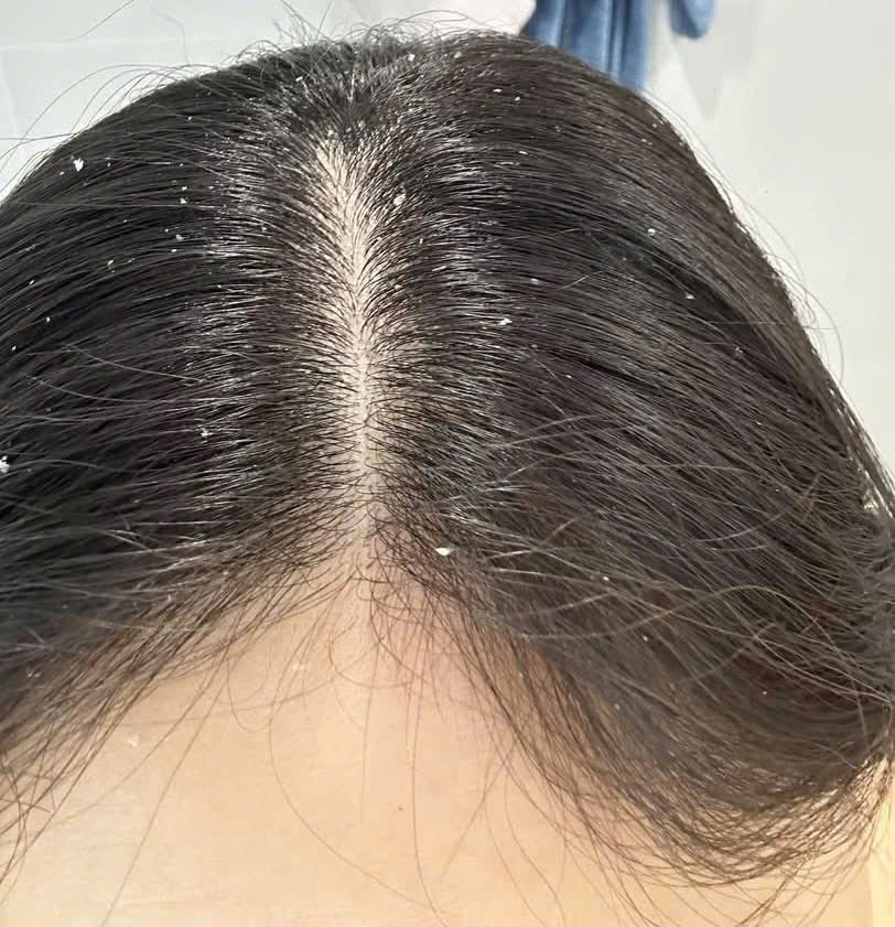 Cách trị gàu tận gốc, lấy lại da đầu sạch khỏe