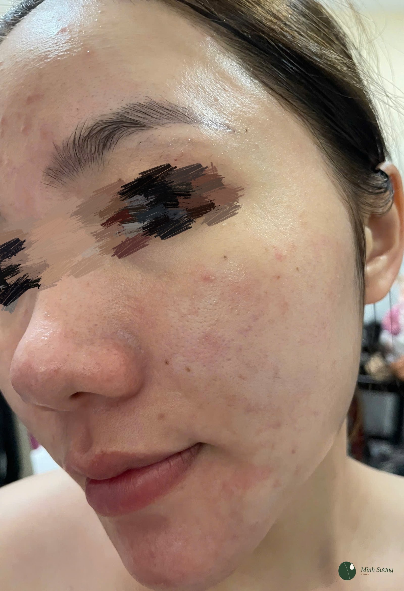 Da Nhạy Cảm, Da Bị Kích Ứng: Cách Chăm Sóc An Toàn Theo Khoa Học